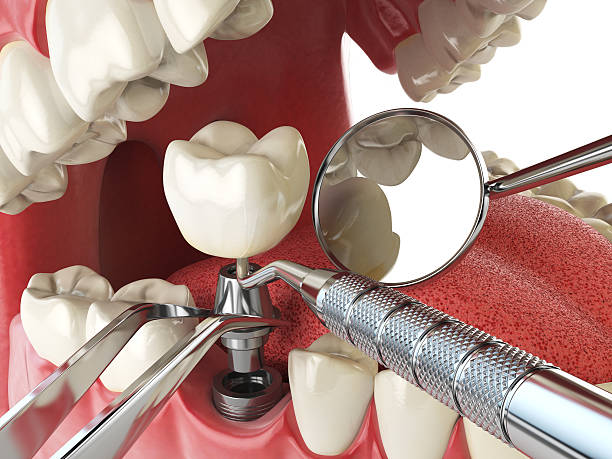 Best Emergency Wisdom Tooth Extraction in Muskegon, MI